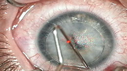 image salle grreffe cataracte
